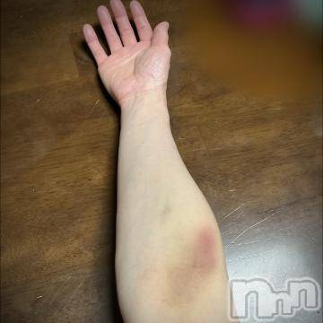 新潟デリヘル五十路マダム新潟店(カサブランカグループ)(イソジマダムニイガタテン) 夏目みな(51)の2月8日写メブログ「痣」