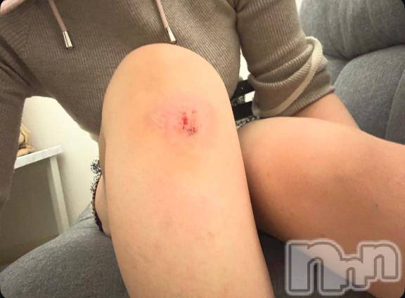 新潟デリヘルMelt(メルト)むぎ(26)の2026年3月4日写メブログ「負傷」