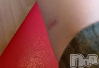 上越デリヘル HONEY(ハニー) みさき(♪)(47)の3月19日写メブログ「ケロイド治療」